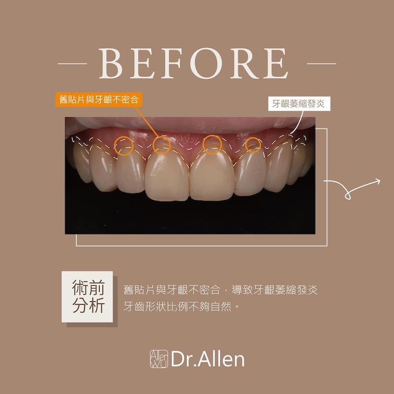 牙齒貼片-陶瓷貼片-舊貼片不密合-牙齦萎縮-療程前-吳國綸醫師-台中