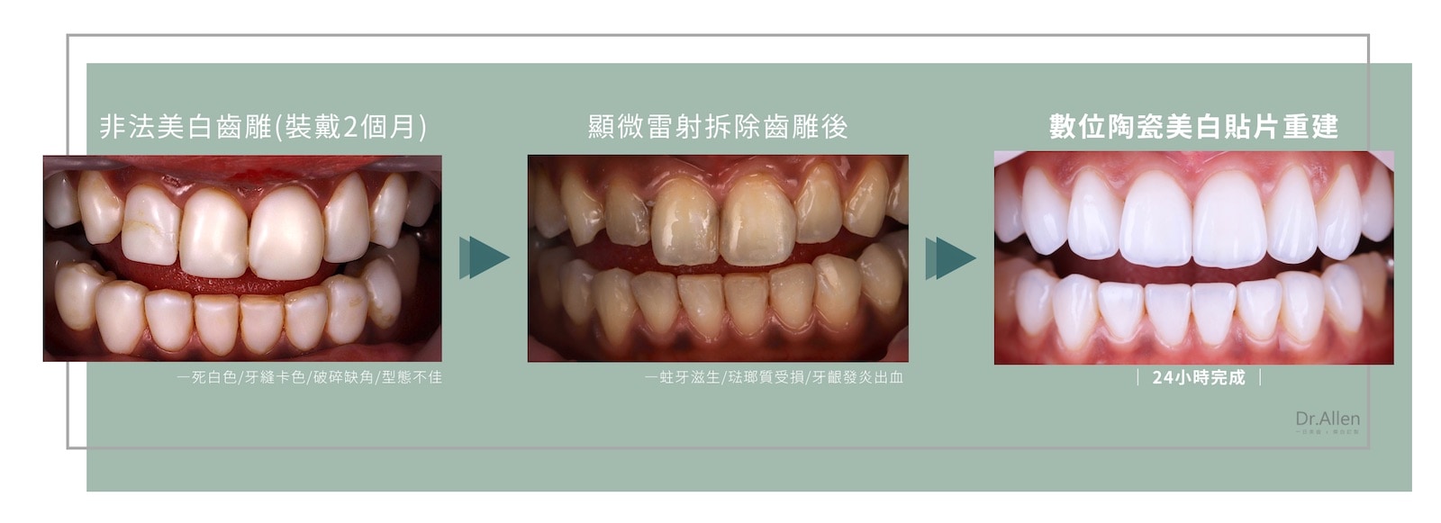 最新陶瓷貼片價格懶人包 陶瓷貼片 美白齒雕大解密 吳國綸醫師