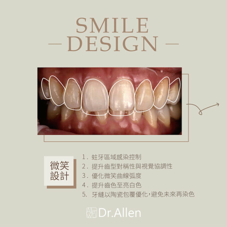 陶瓷貼片解決樹脂補門牙變色、牙齒黃，8小時內快速變美 - 吳國綸醫師